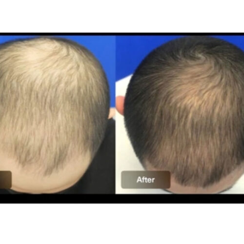 Minoxidil 5% with Finasteride 0.3% (Propecia) Serum 3pcs | For Men and Women